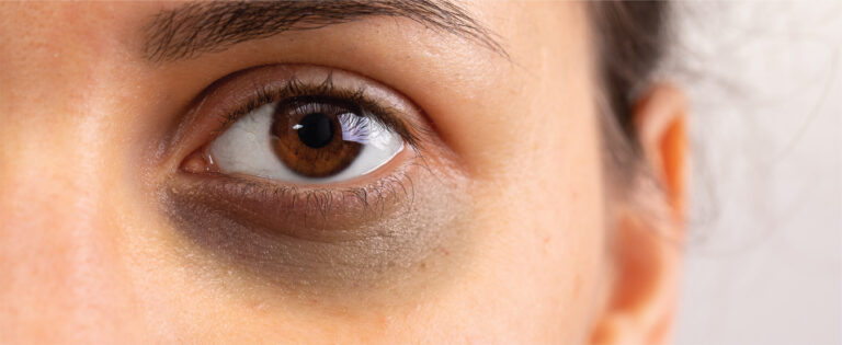 Ayurveda For Dark Circles