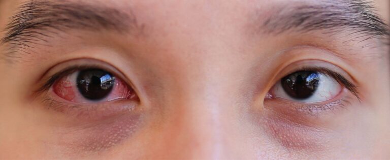 Eye Conjunctivitis