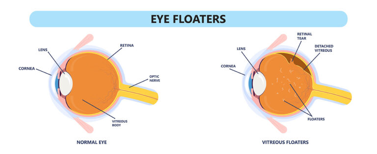 Eye Floaters