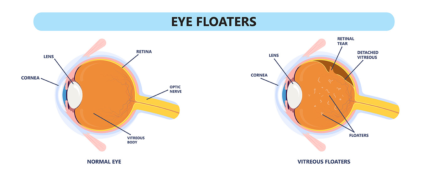 Eye Floaters in Different Age Groups: What You Need to Know