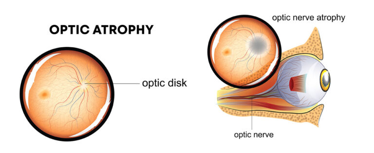 Optic Atrophy Treatment