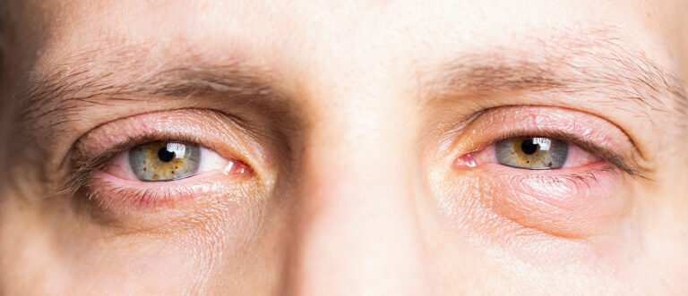 eye conjunctivitis treatment