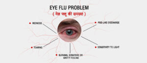Eye Flu Treatment