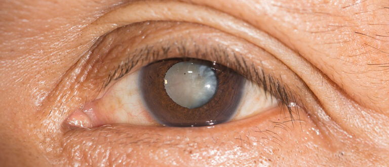 Cataract