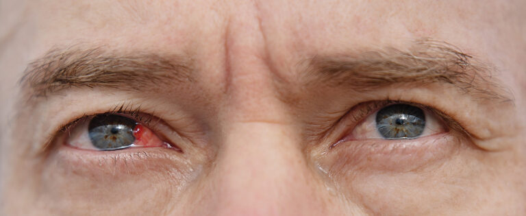 Eye Conjunctivitis