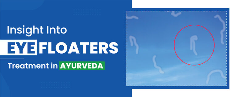 Eye Floaters Treatment in Ayurveda