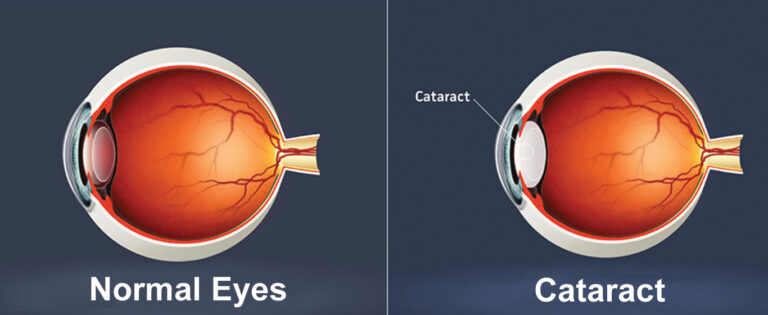 Ayurvedic Treatment for Cataract