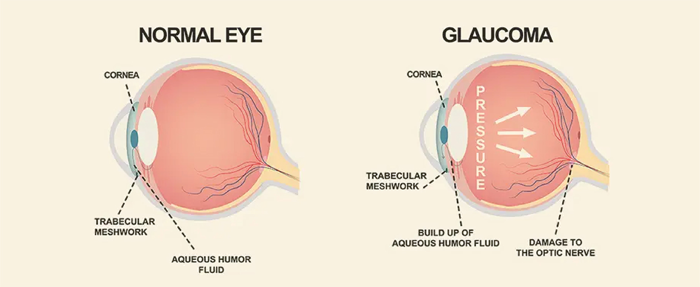Ayurvedic medicine for glaucoma