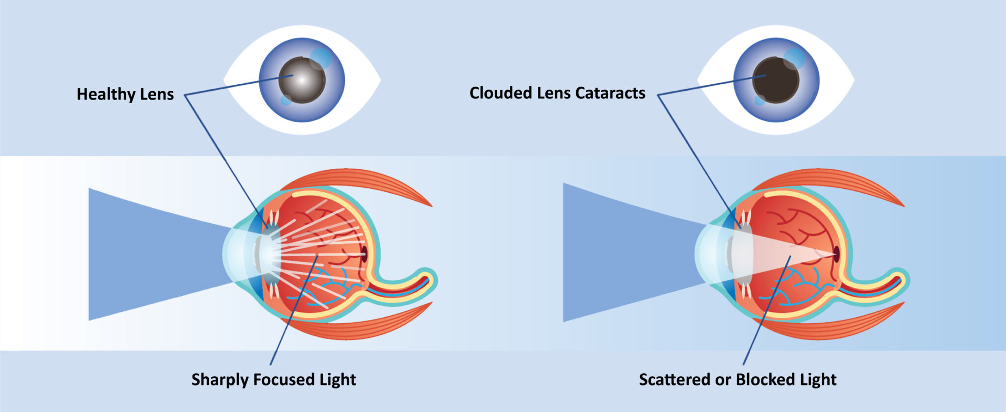 Main Cause Of Cataract & It’s Ayurvedic Treatments