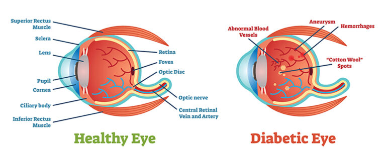 Diabetic Retinopathy