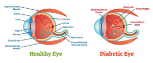 diabetic retinopathy